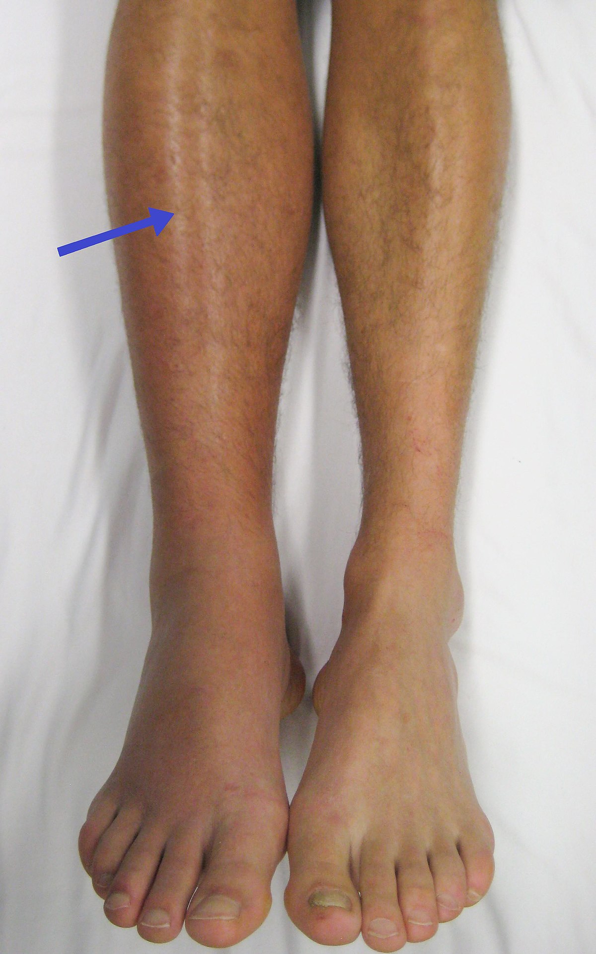 Featured image of post Blood Clot In Calf Symptoms Pictures