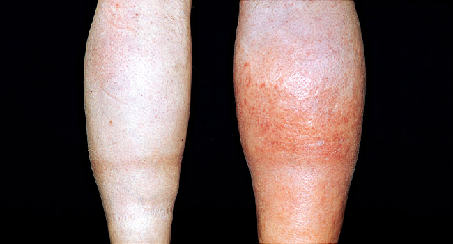 Featured image of post Pictures Of Blood Clot In Calf Of Leg